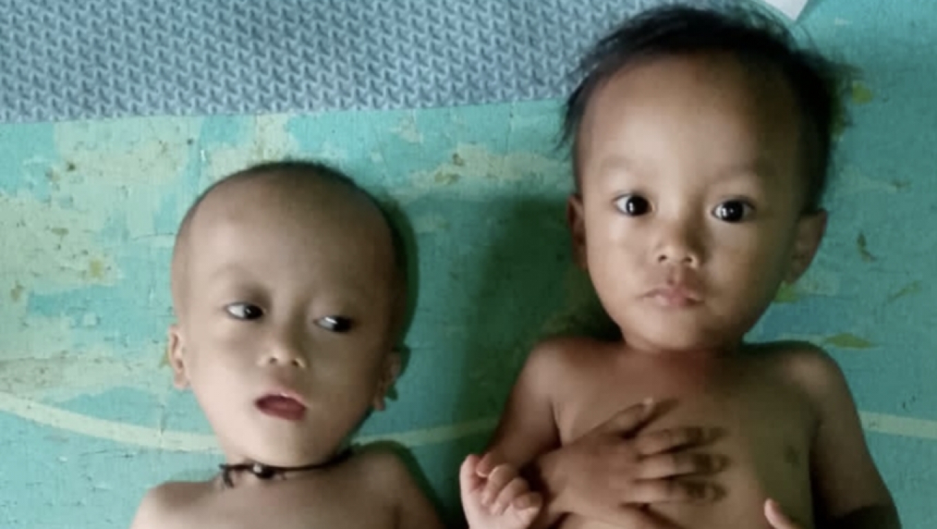 Kondisi bayi kembar bernama Nopal dan Ripal asal Labuan, Kabupaten Pandeglang, yang menderita stunting. 